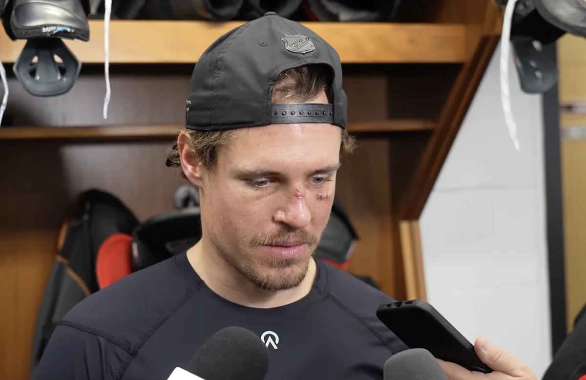 L'entrevue de la honte: Nick Cousins choque avec son visage tuméfié